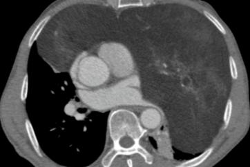 妙手「拆弹」解重负 七旬老人获新生