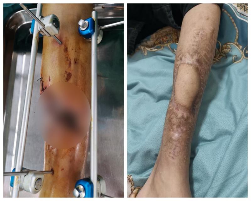 13 岁少年小腿骨折后感染坏死，合肥京东方医院两年「保肢战」