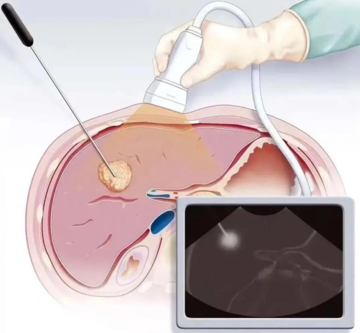 结肠癌肝转移,35 次化疗后他不愿放弃,在中国获精准手术救治,实现无瘤生存目标