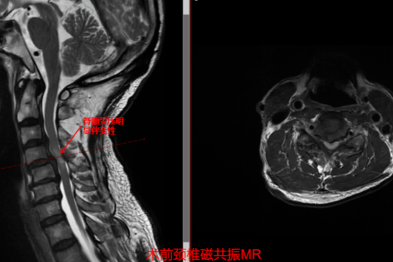 妙手解危局，仁术护安康  市中心医院脊柱外科助高龄危重颈椎病患者重获新生