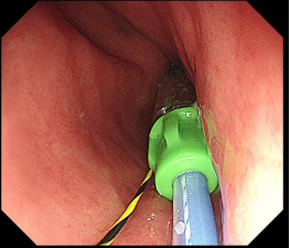 28 岁小伙 200 斤，在内镜下找到「减重新通路」