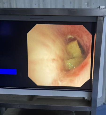 夜闯生命隘口，70 分钟凿通窒息绝境