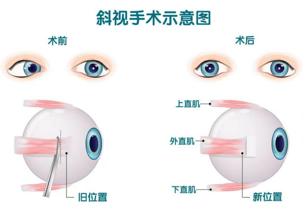 「对眼」拖 7 年，再晚一些，孩子立体视可能永远回不来