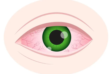 春天眼睛痒个不停怎么办？可能是你的鼻子导致的...