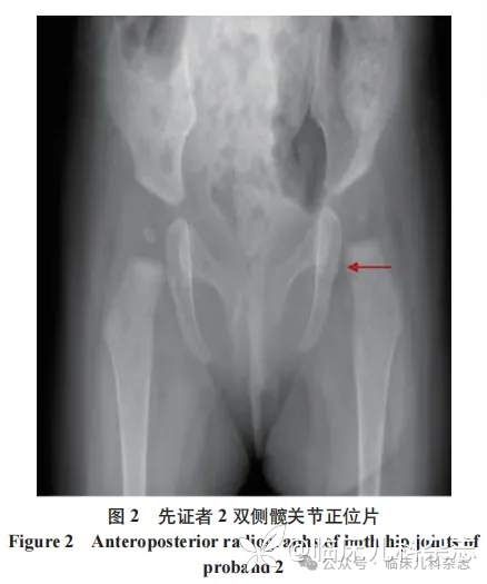 基于 X 染色体失活分析探讨 2 例 X 连锁智力障碍 Bain 型患儿的临床与遗传学特征