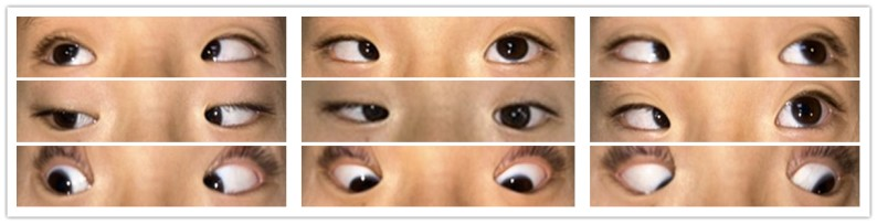 「对眼」拖 7 年，再晚一些，孩子立体视可能永远回不来