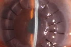 一枚角膜的生命接力——辽宁爱尔眼科医院为角膜溃疡患者成功实施板层移植