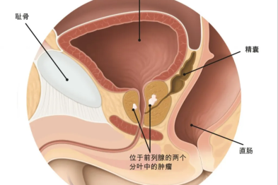 守护父亲与丈夫的健康：前列腺癌筛查，一份不该被忽视的提醒