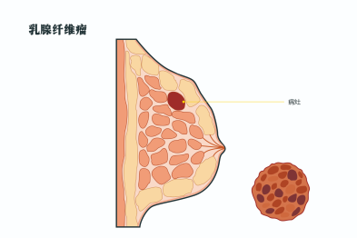 护胸不踩坑，40+女性必看乳腺指南