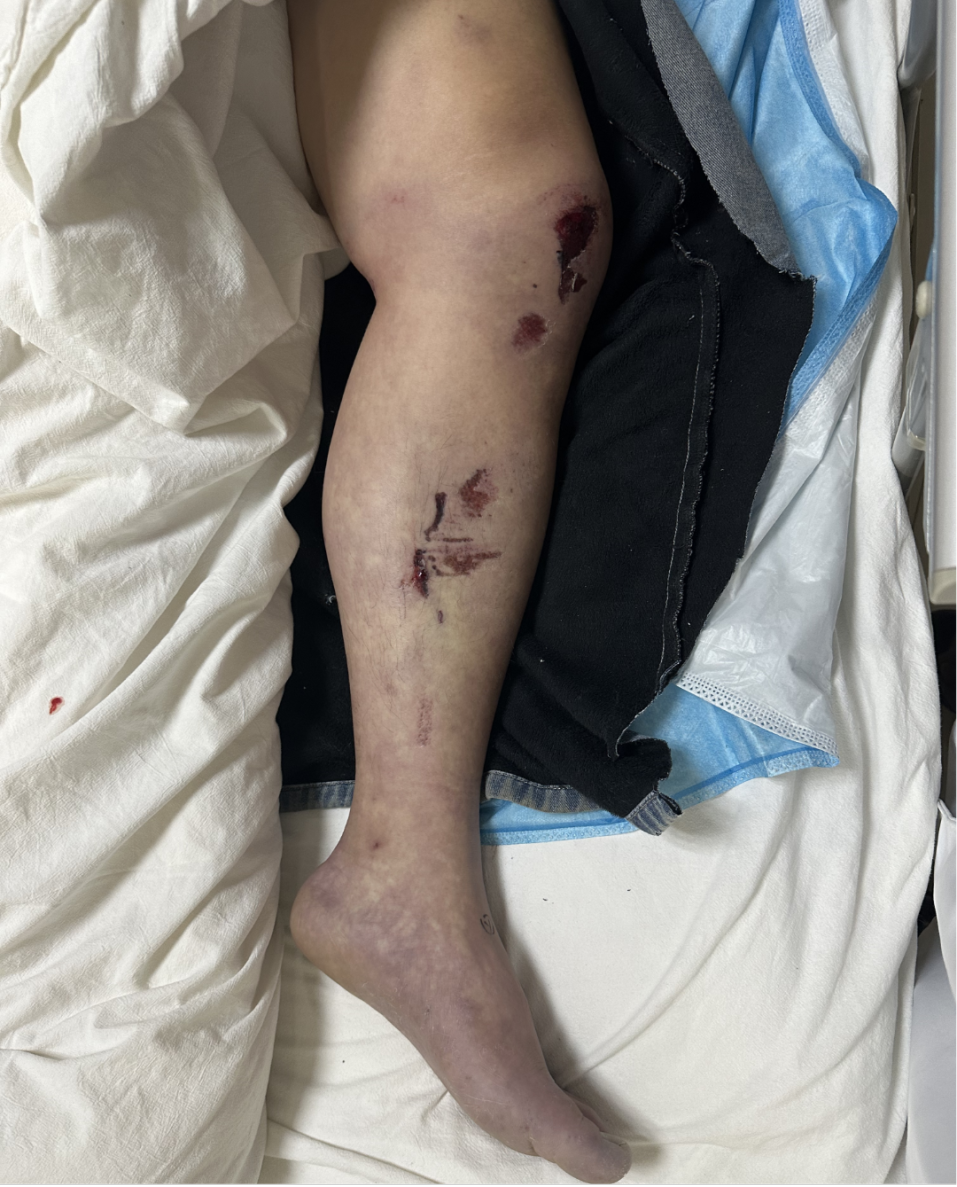 黔江中心医院创伤中心成功救治严重车祸伤患者!