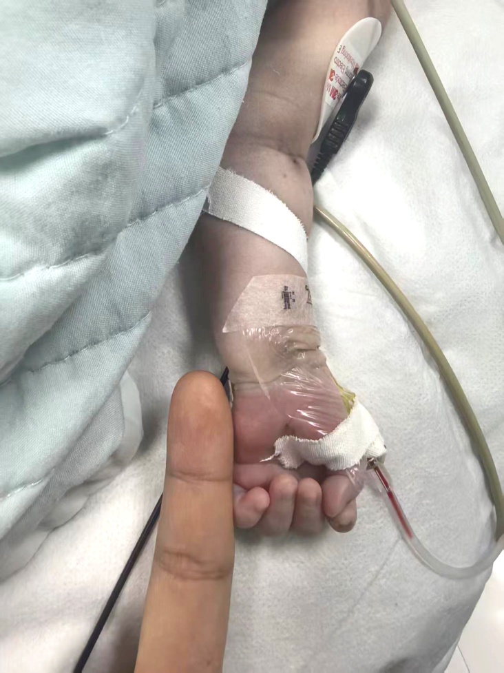 出生仅 4 天、体重 2.4 公斤!亚心专家微创技术为早产「紫娃娃」打通紧闭「心门」