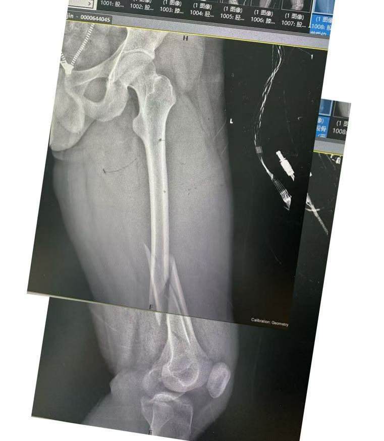 黔江中心医院创伤中心成功救治严重车祸伤患者!