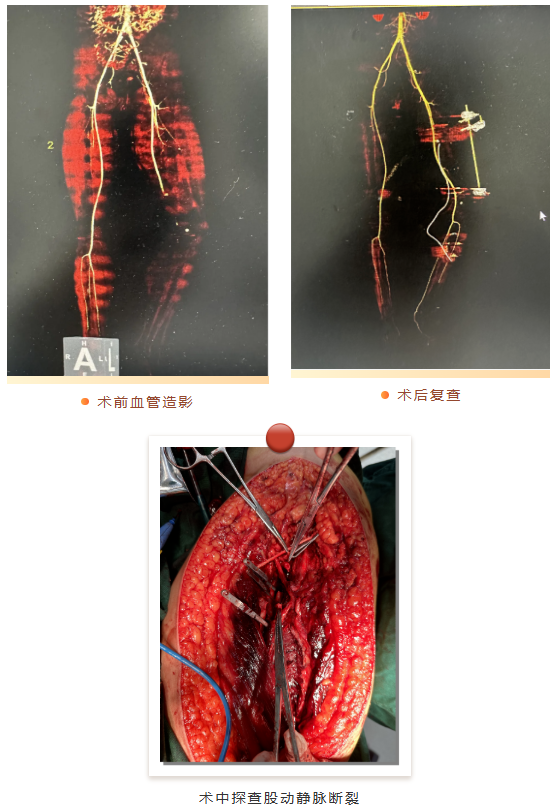 黔江中心医院创伤中心成功救治严重车祸伤患者!