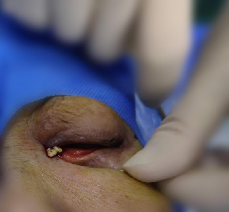 流泪流脓 1 年治不好？这种复杂泪道病，别再盲目滴眼药水了