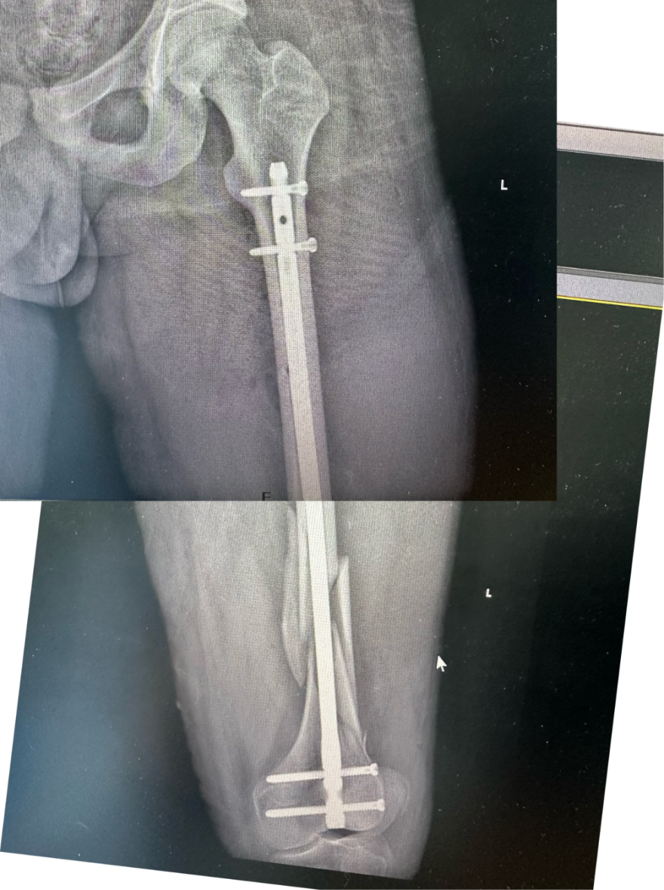黔江中心医院创伤中心成功救治严重车祸伤患者!