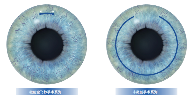 春季摘镜全攻略：近视手术前你必须知道的那些事！