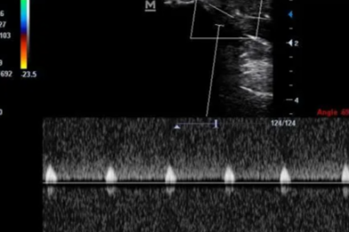 81 岁奶奶术后休克命悬一线！ICU「透视眼」开挂，从鬼门关抢回生命