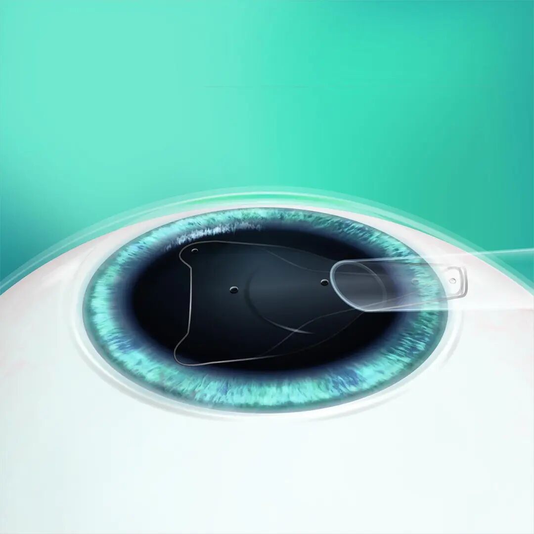 春季摘镜全攻略：近视手术前你必须知道的那些事！