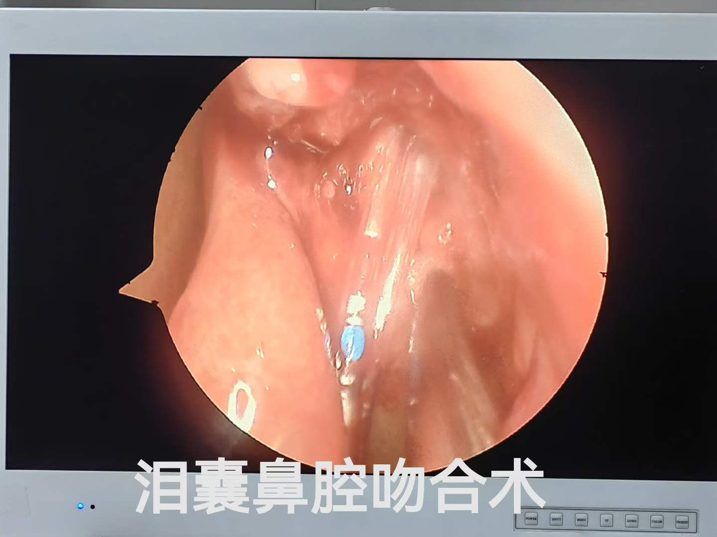 流泪流脓 1 年治不好？这种复杂泪道病，别再盲目滴眼药水了