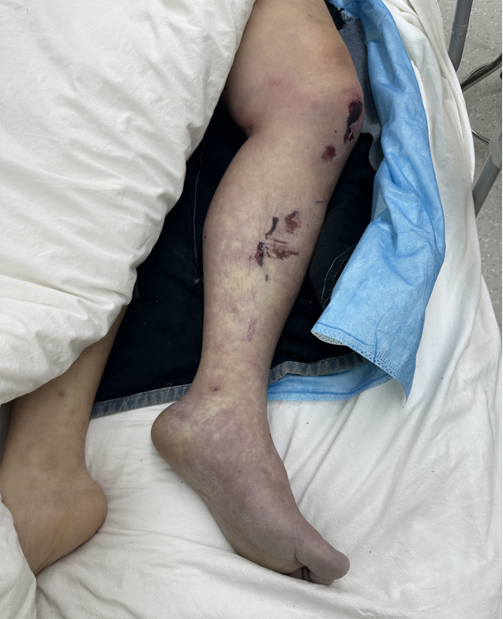 黔江中心医院创伤中心成功救治严重车祸伤患者!