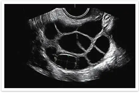 读懂超声卵泡监测,抓住备孕黄金期
