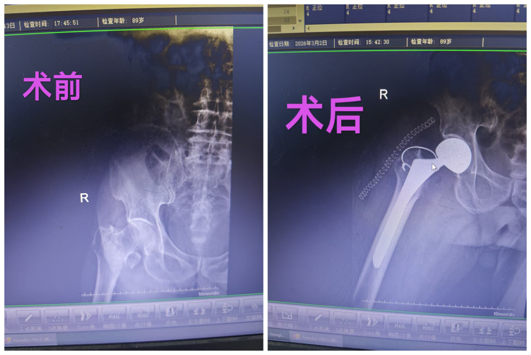 高龄不是禁区!89 岁河南老人开荒摔骨折,人工股骨头置换术后重获行走能力!