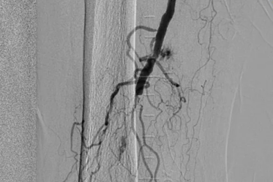 【协作组解病忧】高龄不设限，二附院救治 90 岁下肢动脉闭塞患者