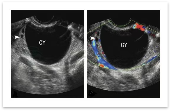 读懂超声卵泡监测,抓住备孕黄金期