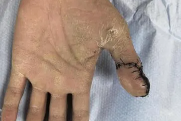 26 岁小伙拇指离断，足趾「移花接木」成功再造——我院手足显微外科团队完成高难度拇指再造术