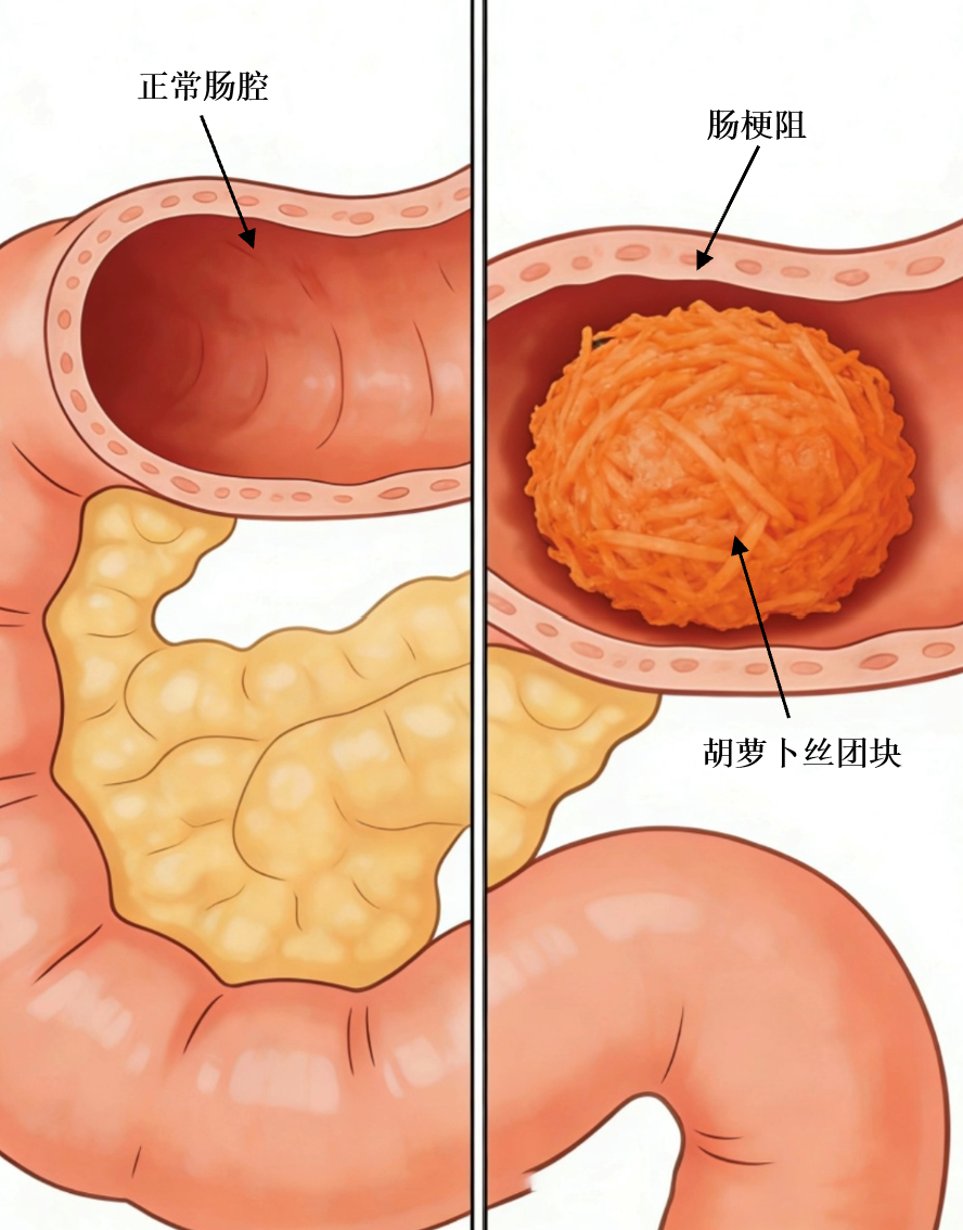 菜夹馍大赛吃出肠梗阻?医生紧急提醒:这种「健康食物」千万别这么吃!