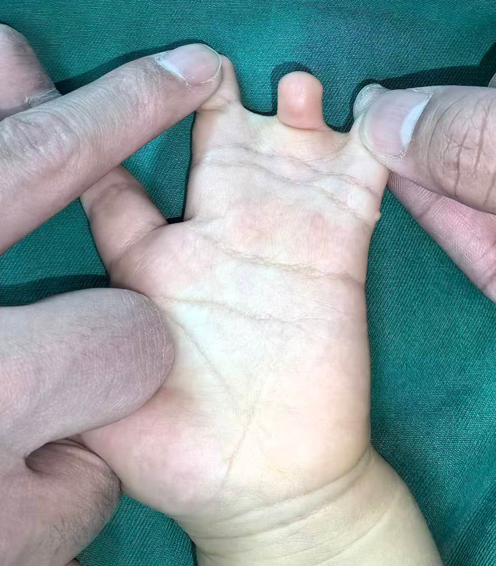 河北 1 岁宝宝手足畸形获精准矫正 健康小手小脚顺利「出道」