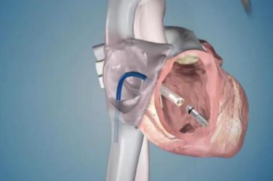 郑州市中心医院为 90 岁高龄患者成功实施无导线起搏器手术