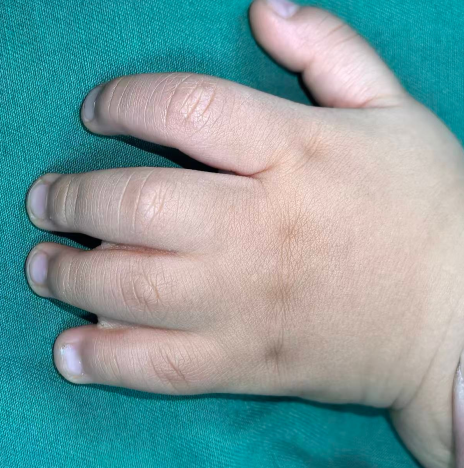 河北 1 岁宝宝手足畸形获精准矫正 健康小手小脚顺利「出道」