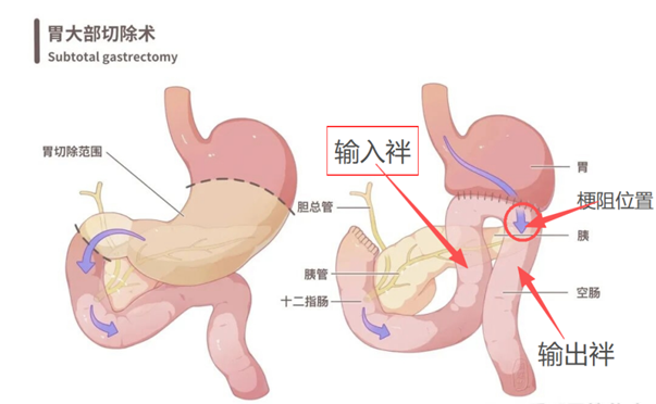 肿瘤患者腰疼不一定是骨转移，吃不下饭未必是绝境 合肥京东方医院多学科协作，破解两大疑难病例