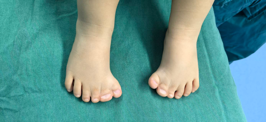 河北 1 岁宝宝手足畸形获精准矫正 健康小手小脚顺利「出道」