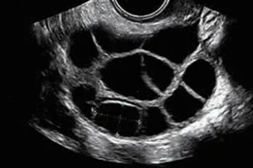 读懂超声卵泡监测，抓住备孕黄金期