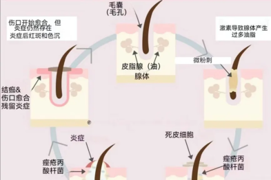 【二附院医生说】痘痘反反复复？带你全面认识「痤疮」