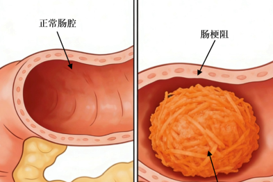 菜夹馍大赛吃出肠梗阻？医生紧急提醒：这种「健康食物」千万别这么吃！