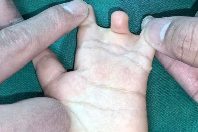 河北 1 岁宝宝手足畸形获精准矫正 健康小手小脚顺利「出道」