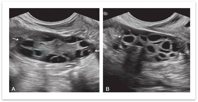 读懂超声卵泡监测,抓住备孕黄金期