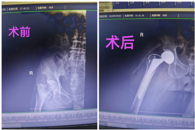 高龄不是禁区！89 岁河南老人开荒摔骨折，人工股骨头置换术后重获行走能力！