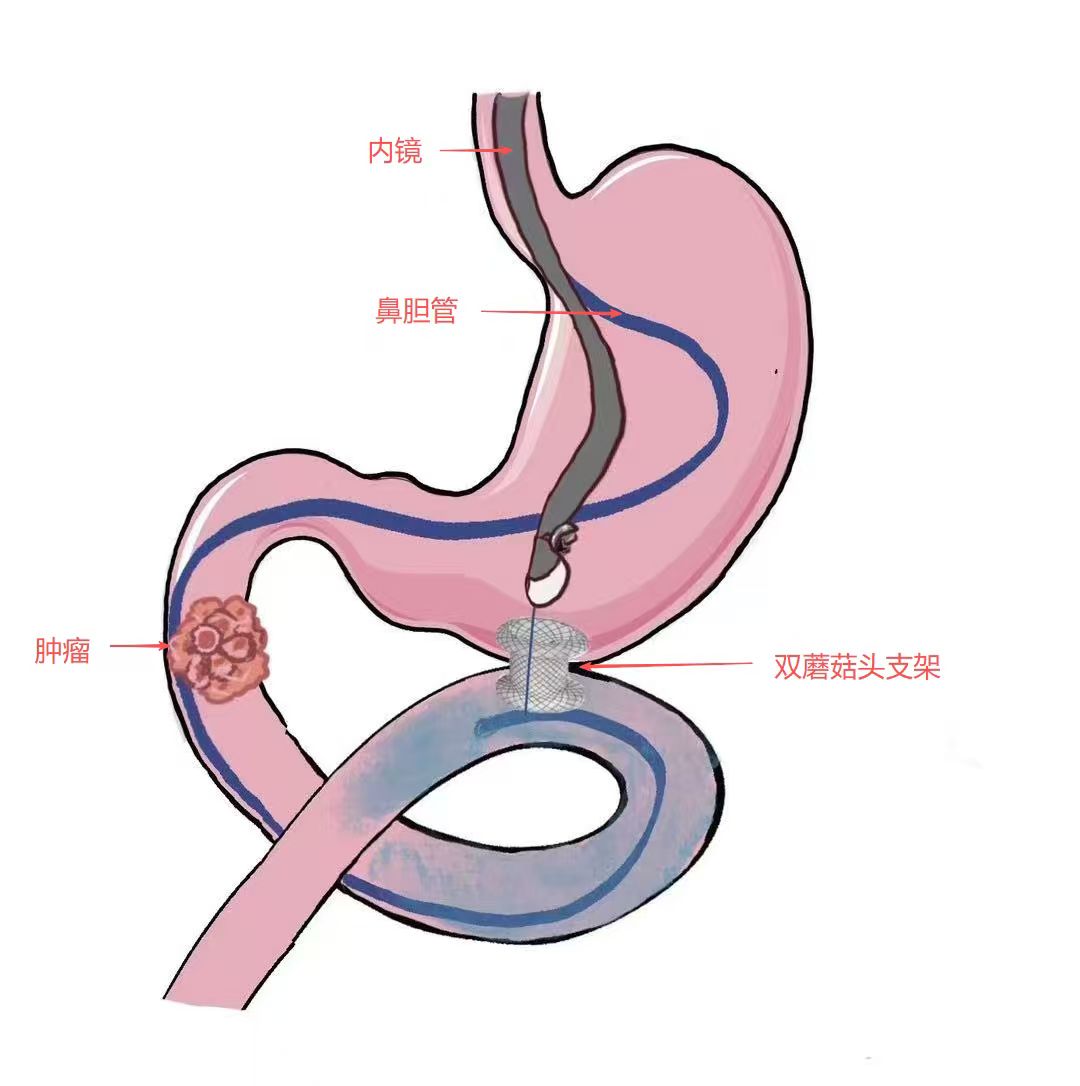 81 岁老人「滴水不进」，医生在他肚子里搭了座「高架桥」