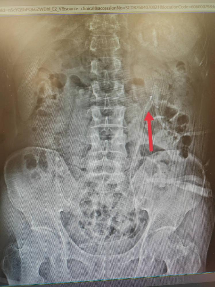 周逢海主任团队成功实施一例单一微通道经皮肾镜碎石取石术