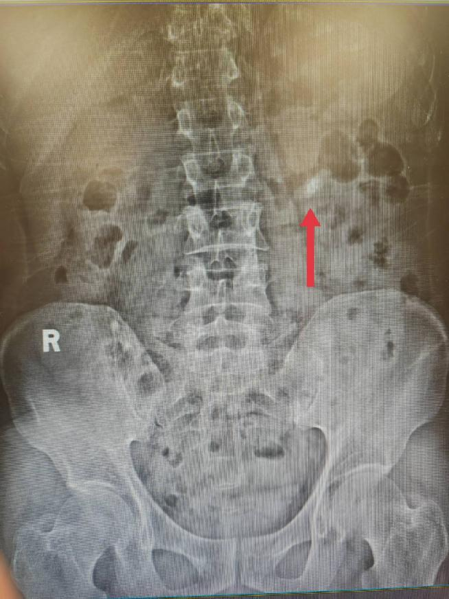 周逢海主任团队成功实施一例单一微通道经皮肾镜碎石取石术
