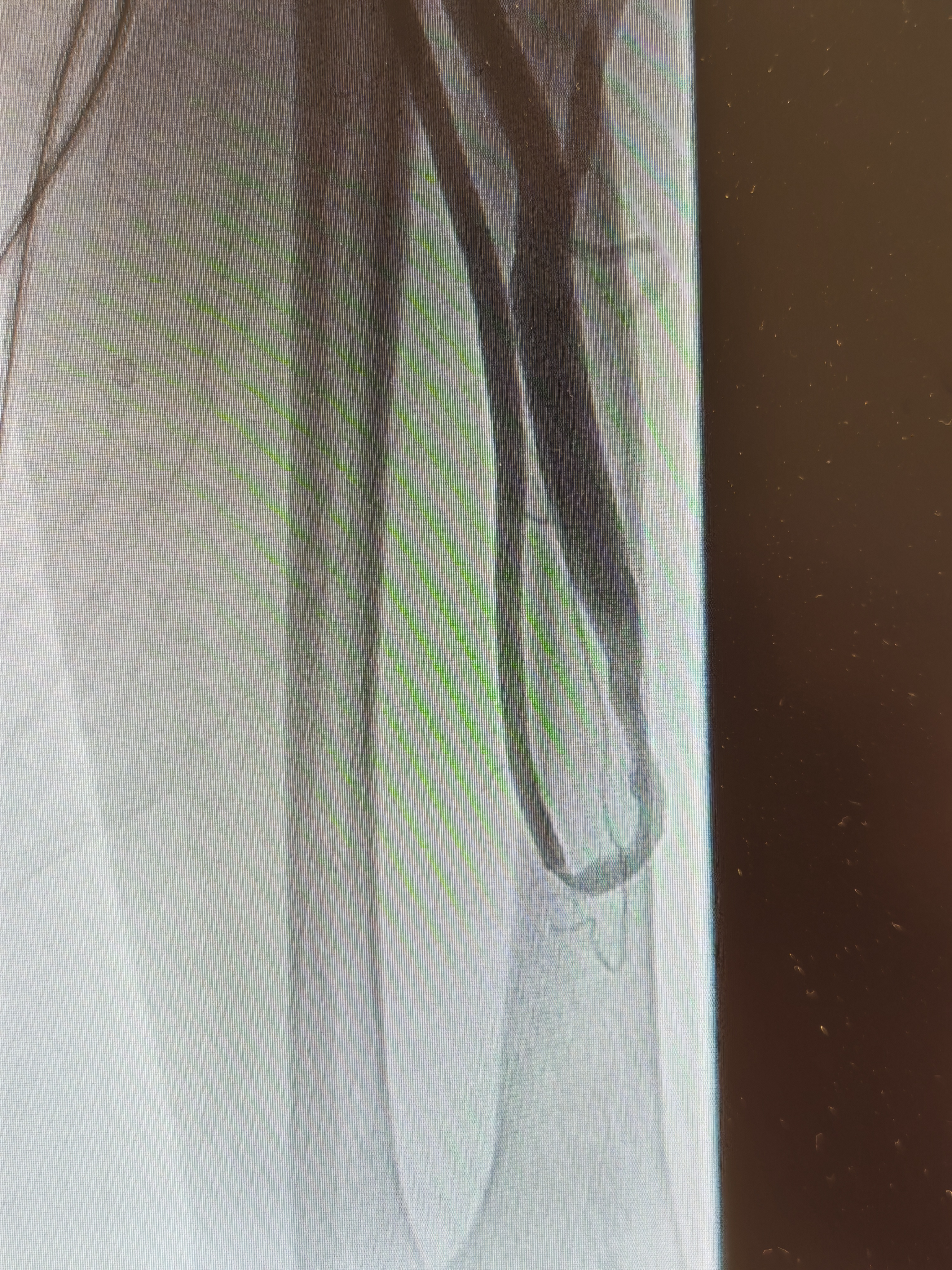 打通「生命线」!四川泰康医院 成功完成复杂血透通路介入再通术