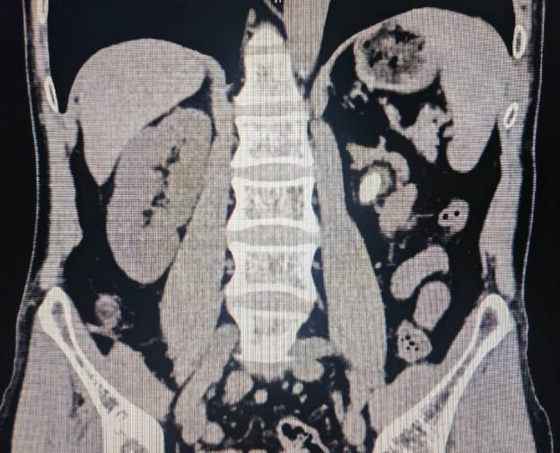 周逢海主任团队成功实施一例单一微通道经皮肾镜碎石取石术