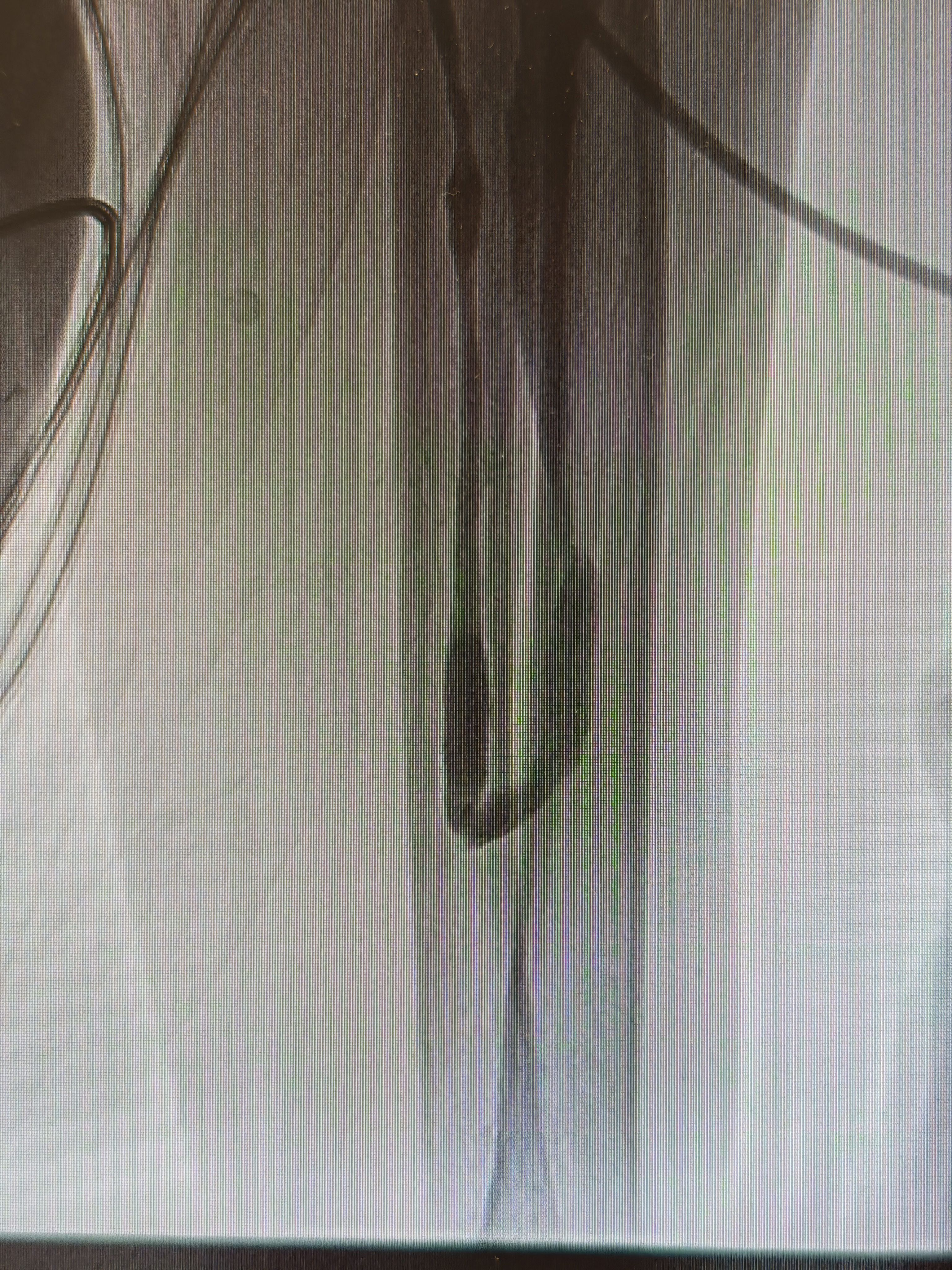 打通「生命线」!四川泰康医院 成功完成复杂血透通路介入再通术