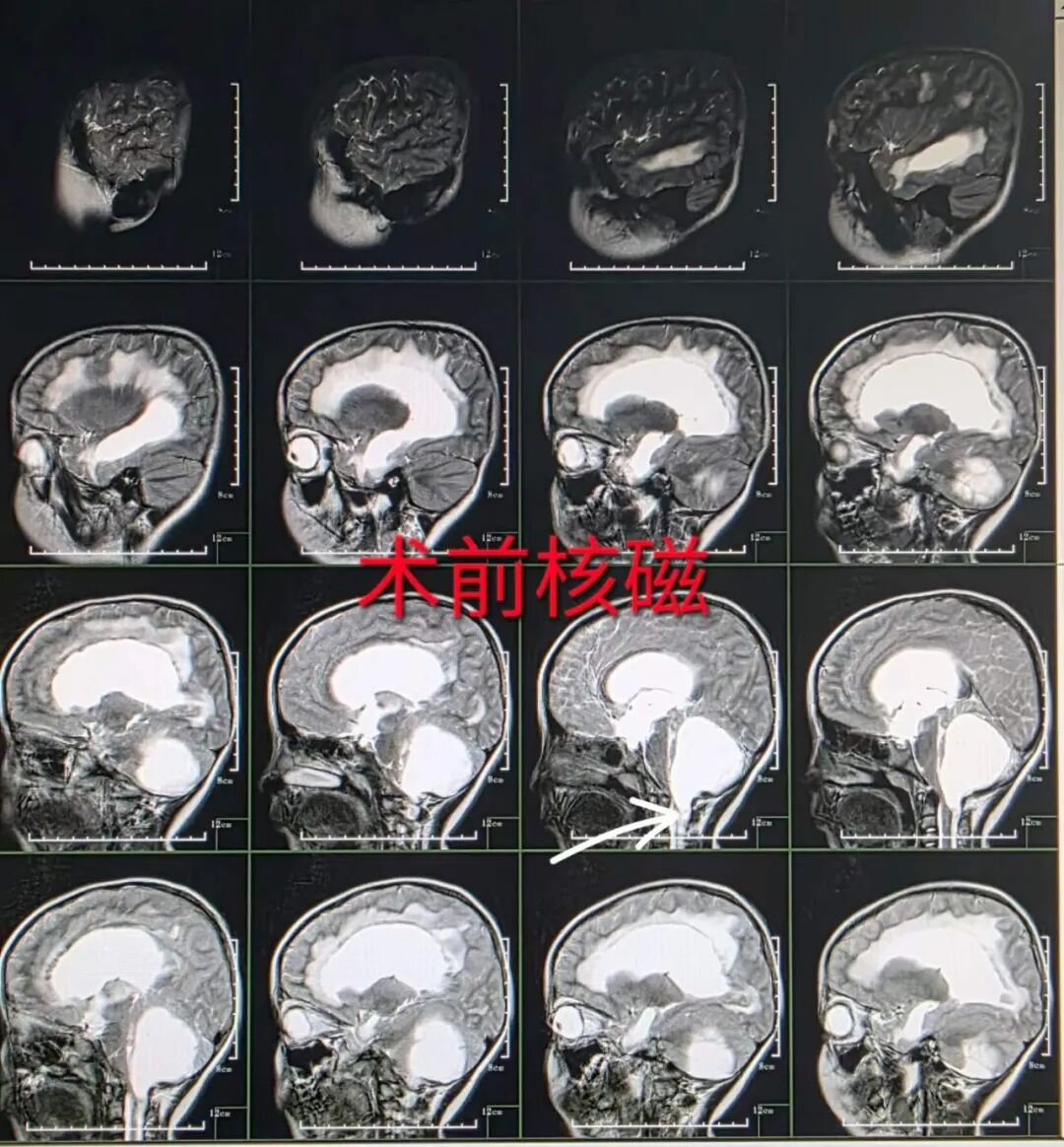 「苹果大」脑瘤压住 5 岁娃命门！小脑被挤 2/3，打个喷嚏就完了…