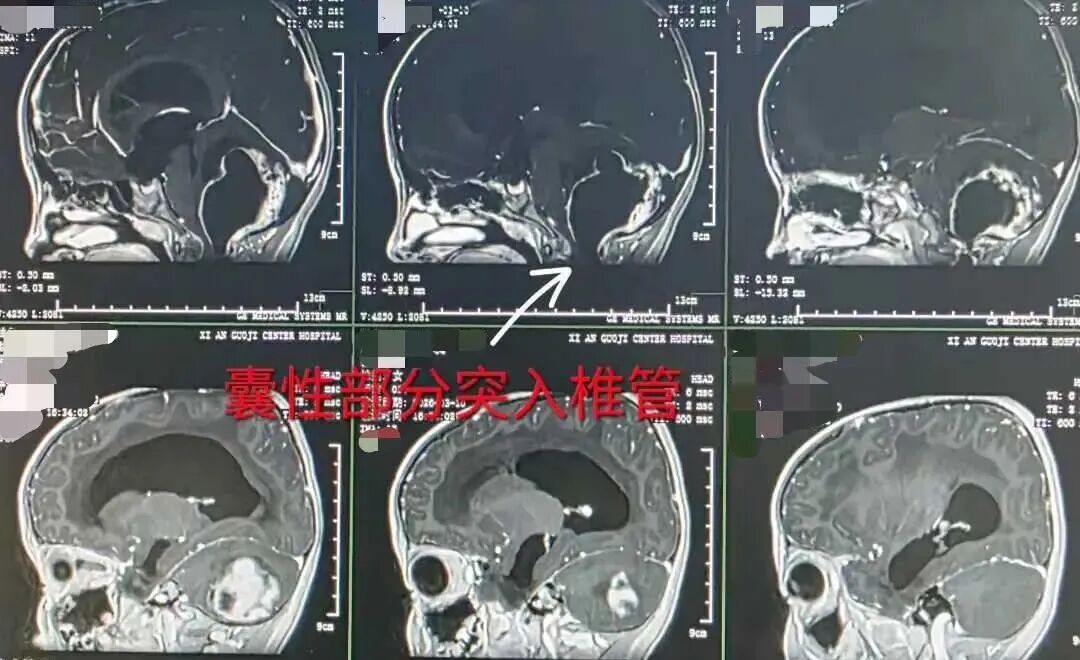 「苹果大」脑瘤压住 5 岁娃命门！小脑被挤 2/3，打个喷嚏就完了…