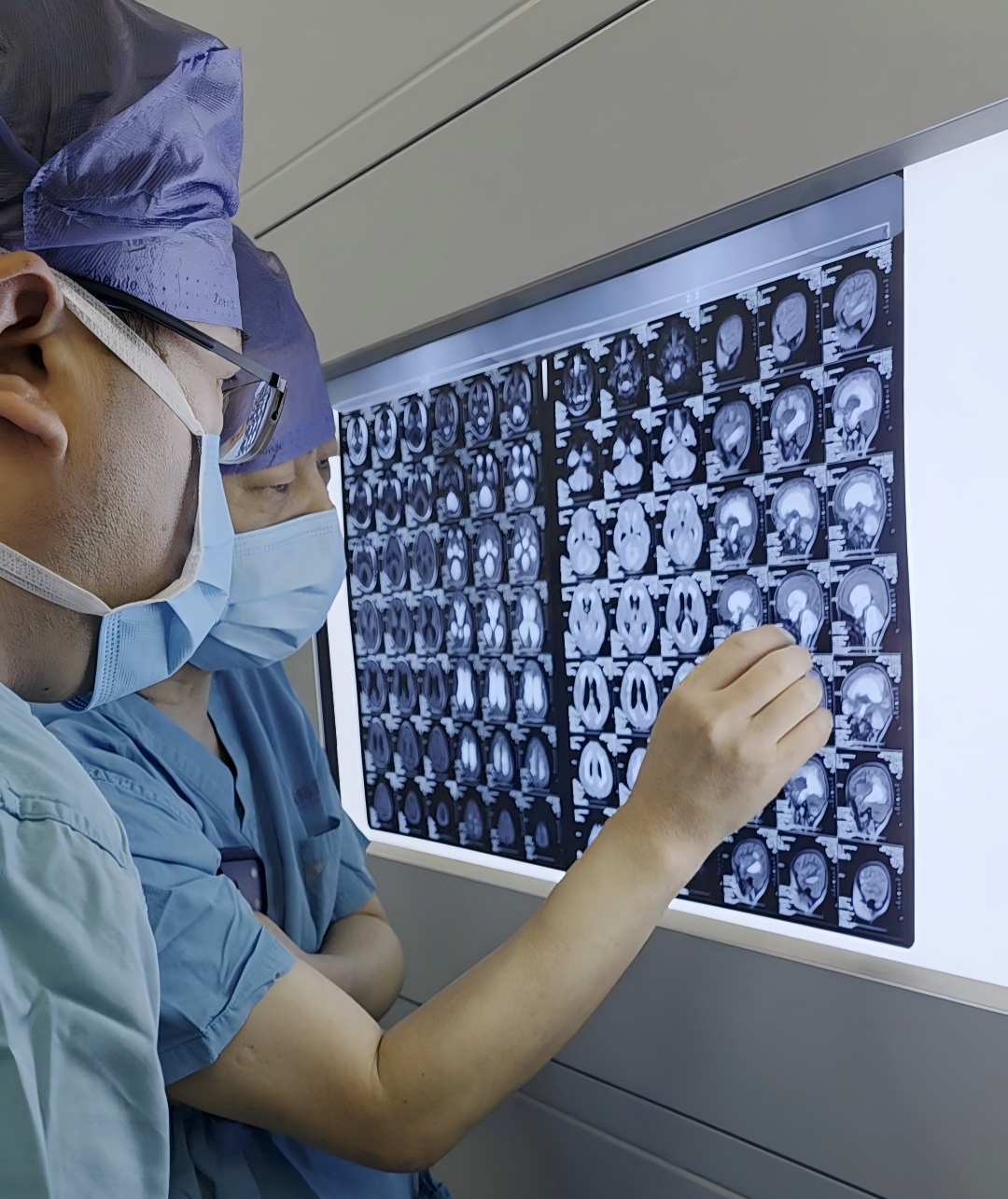 「苹果大」脑瘤压住 5 岁娃命门！小脑被挤 2/3，打个喷嚏就完了…